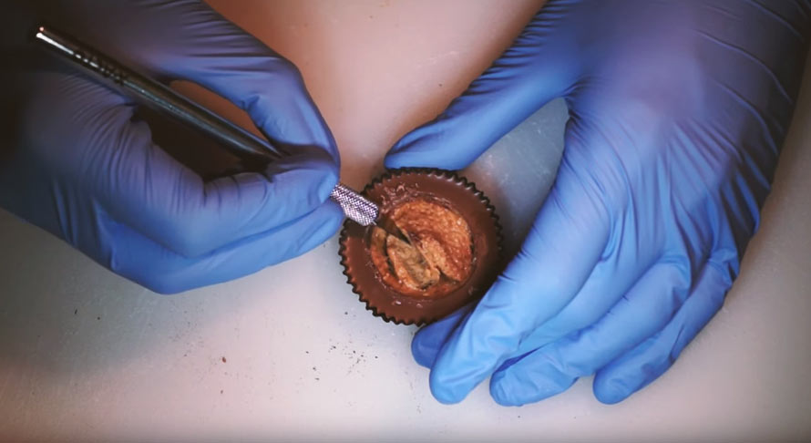 peanut-butter-ectomy